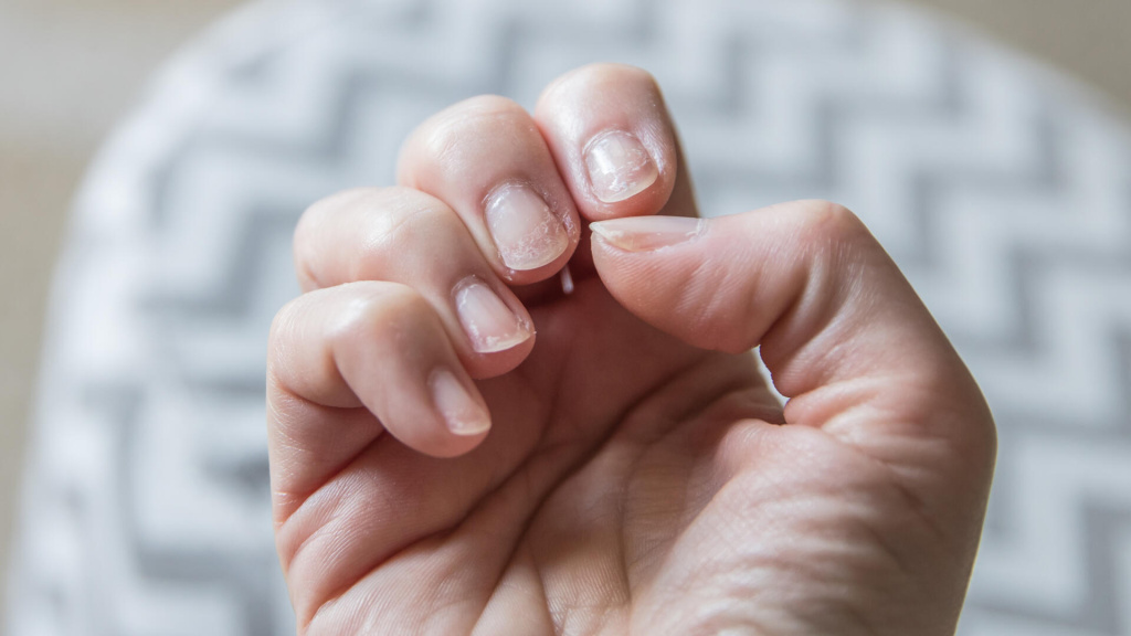 Ломкие ногти из-за недостатка микроэлементов
