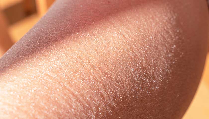 Сухость кожи и зуд