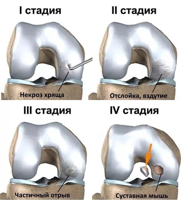 Способы лечения болезни кенинга